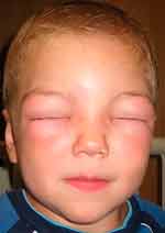 Аллергическая реакция у ребенка - отек Квинке