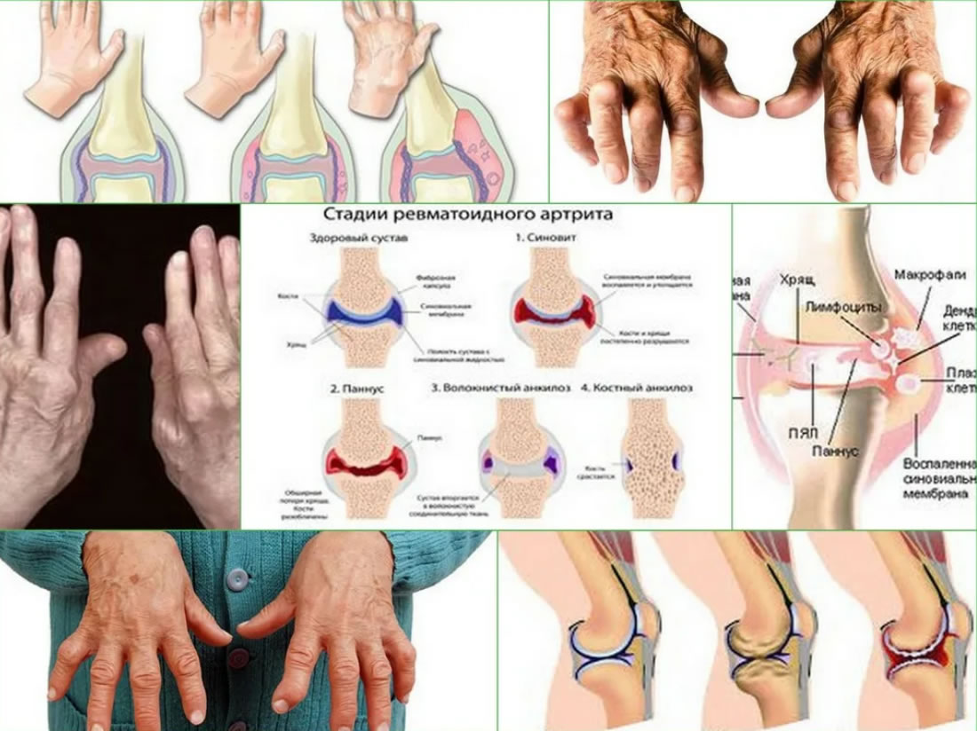 Стадии ревматоидного артрита