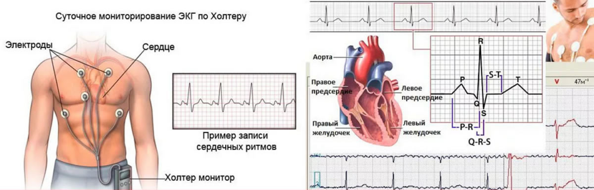 Суточное ЭКГ по Холтеру- информативное исследование сердца